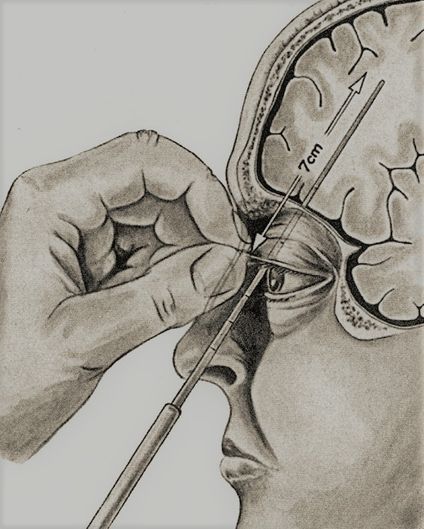 Lobotomi var ett kirurgisk metod där man skar av vissa nervbanors förbindelse med delar av hjärnan som har med känslor göra. Ingreppet var både komplicerat och riskfyllt.